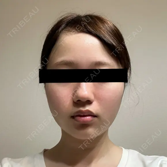 糸リフト / バッカルファット除去 SEA CLINIC（シークリニック） DAY 15 メイン用