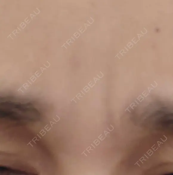 ボトックス（眉間） TCB東京中央美容外科 新横浜院 DAY 33 メイン用