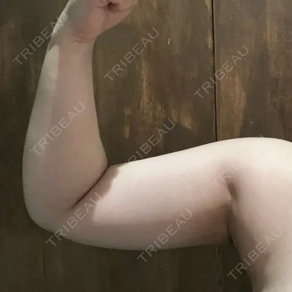 脂肪冷却（二の腕） Anterior 大阪梅田院 DAY 50 メイン用