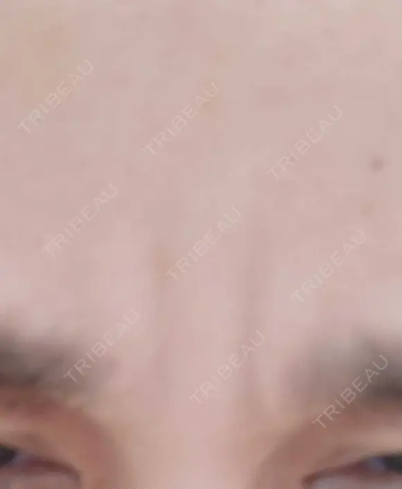 ボトックス（眉間） TCB東京中央美容外科 新横浜院 DAY 34 メイン用