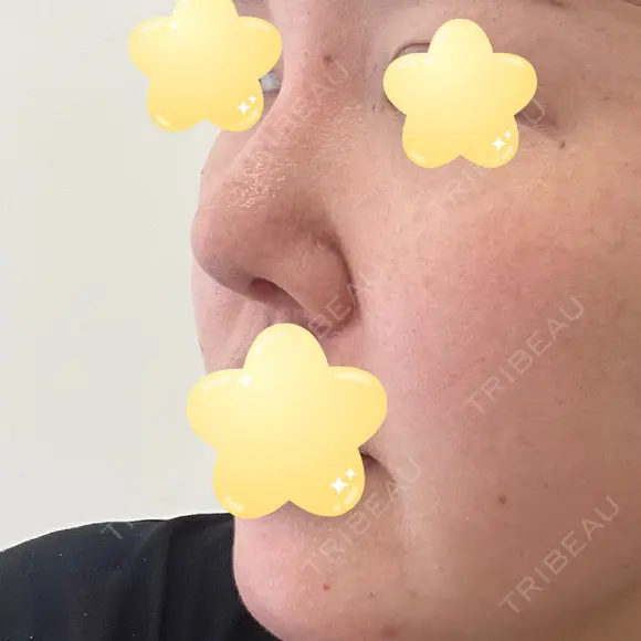 隆鼻術 / 鼻尖形成（切開） / 軟骨移植 エースクリニック 名古屋院 DAY 31 メイン用