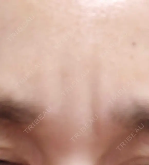 ボトックス（眉間） TCB東京中央美容外科 新横浜院 DAY 34 メイン用