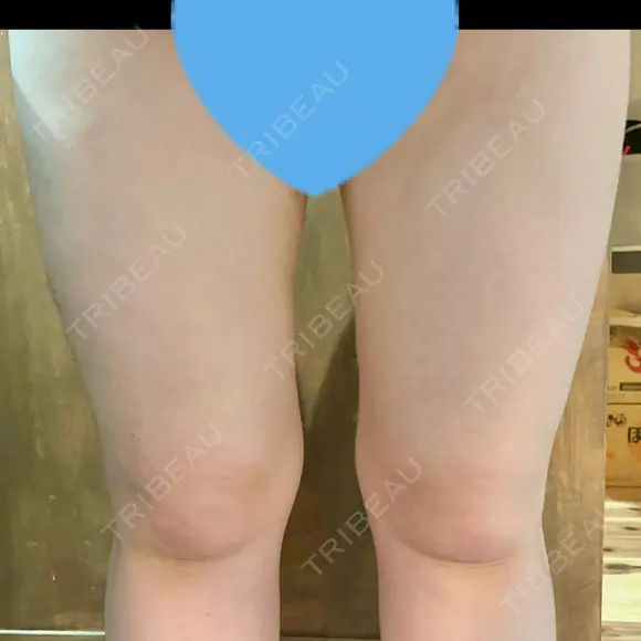 脂肪冷却（太もも） Anterior 大阪梅田院 DAY 7 メイン用