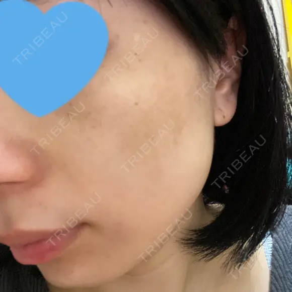 光治療（フォトフェイシャルなど） メディアージュクリニック 名古屋院 DAY 5 メイン用