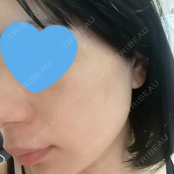 光治療（フォトフェイシャルなど） メディアージュクリニック 名古屋院 DAY 6 メイン用