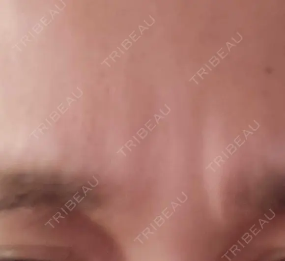 ボトックス（眉間） TCB東京中央美容外科 新横浜院 DAY 35 メイン用