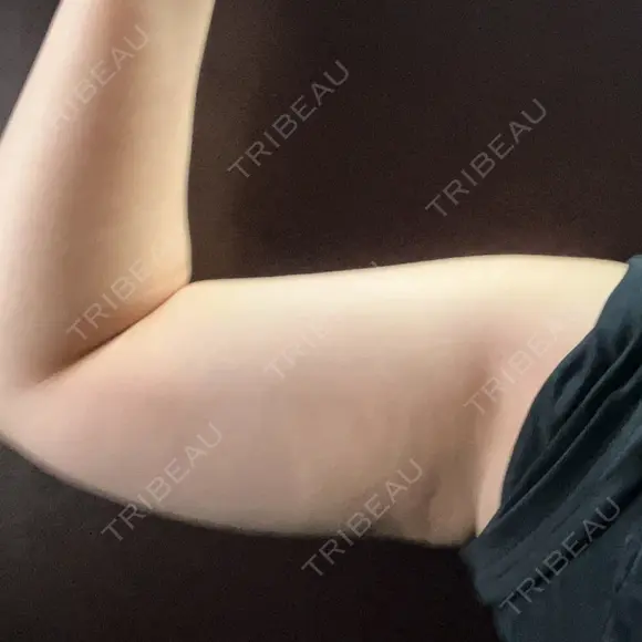 脂肪冷却（二の腕） Anterior 大阪梅田院 AFTER メイン用