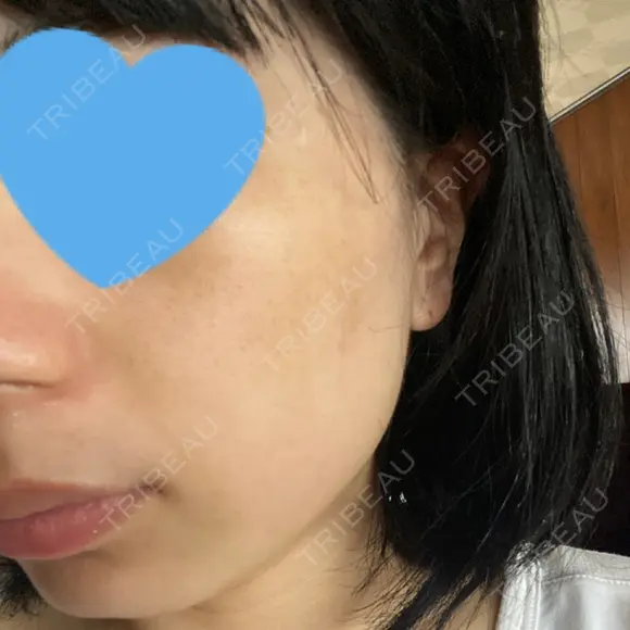 光治療（フォトフェイシャルなど） メディアージュクリニック 名古屋院 DAY 8 メイン用