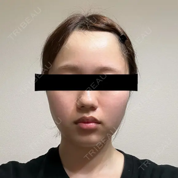 糸リフト / バッカルファット除去 SEA CLINIC（シークリニック） DAY 18 メイン用