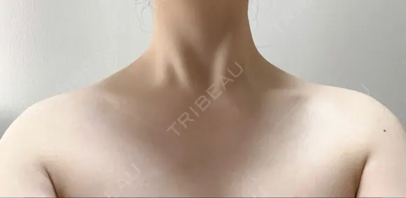 ボトックス（肩） L‘amour clinic Tokyo【ラムールクリニック東京】 AFTER メイン用