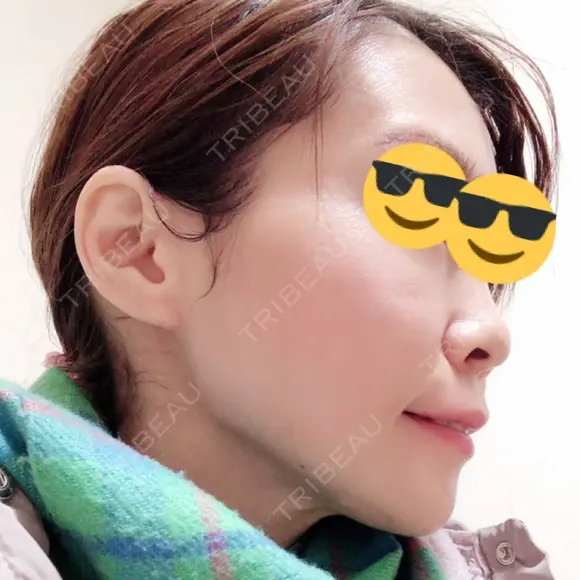 ヒアルロン酸注入（あご） TCB東京中央美容外科 世田谷院 DAY 3 メイン用