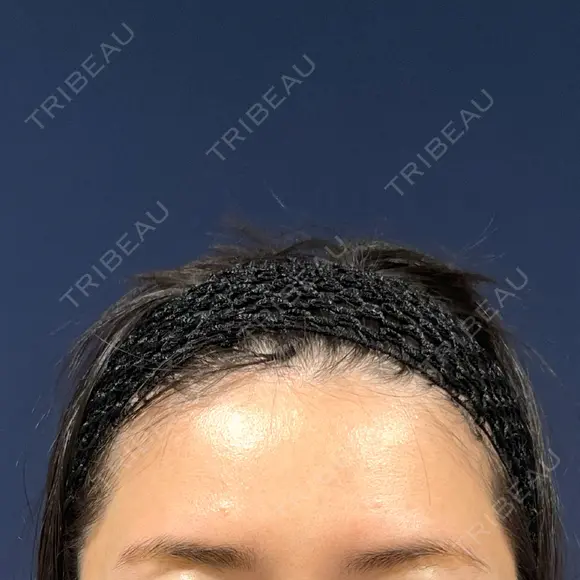 脂肪注入（額） S.T styleクリニック DAY 43 メイン用