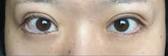 二重埋没 TCB東京中央美容外科 青森院 DAY 21 メイン用