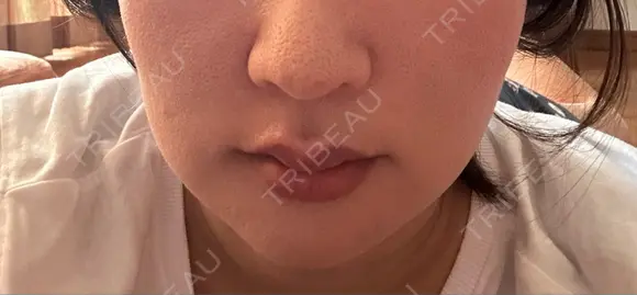 ニードルRF（ポテンツァなど） ゆう美容クリニック DAY 4 メイン用