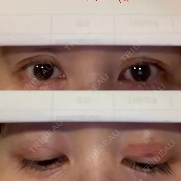 二重埋没 / 糸リフト / 下まぶたの脂肪取り / 目元修正 / 肌ヒアルロン酸注入（たるみ・シワ改善） ネビュラクリニック 広島院 DAY 2 メイン用