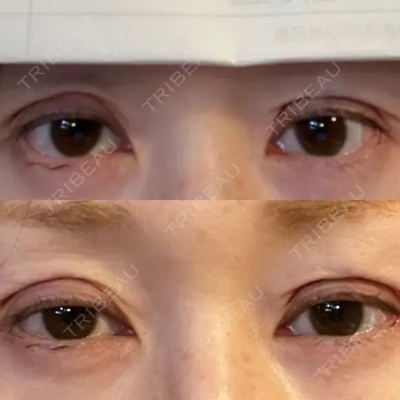 二重埋没 / 糸リフト / 下まぶたの脂肪取り / 目元修正 / 肌ヒアルロン酸注入（たるみ・シワ改善） ネビュラクリニック 広島院 DAY 0 メイン用