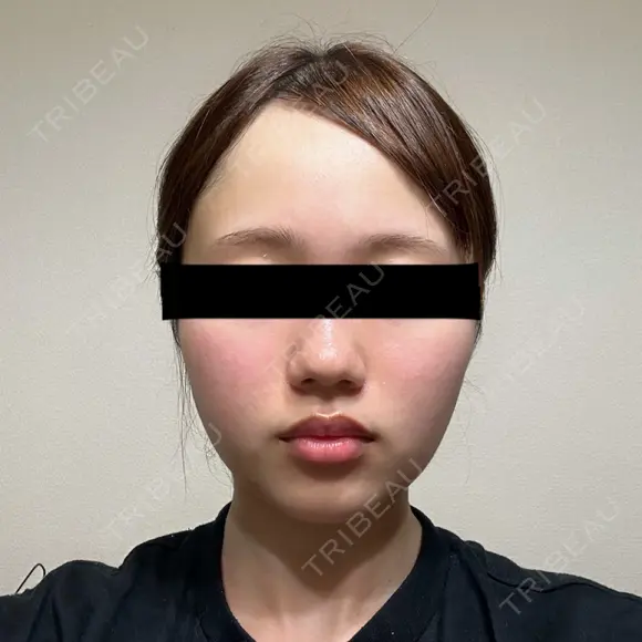 糸リフト / バッカルファット除去 SEA CLINIC（シークリニック） DAY 24 メイン用