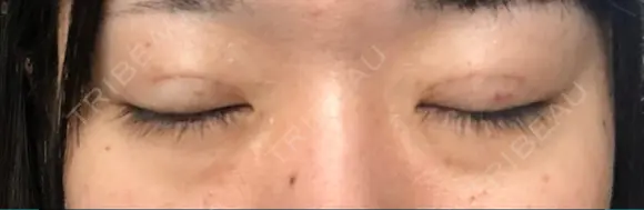 二重埋没 TCB東京中央美容外科 青森院 DAY 22 メイン用