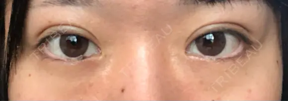 二重埋没 TCB東京中央美容外科 青森院 DAY 22 メイン用