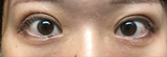 二重埋没 TCB東京中央美容外科 青森院 DAY 23 メイン用