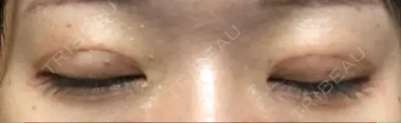 二重埋没 TCB東京中央美容外科 青森院 DAY 23 メイン用