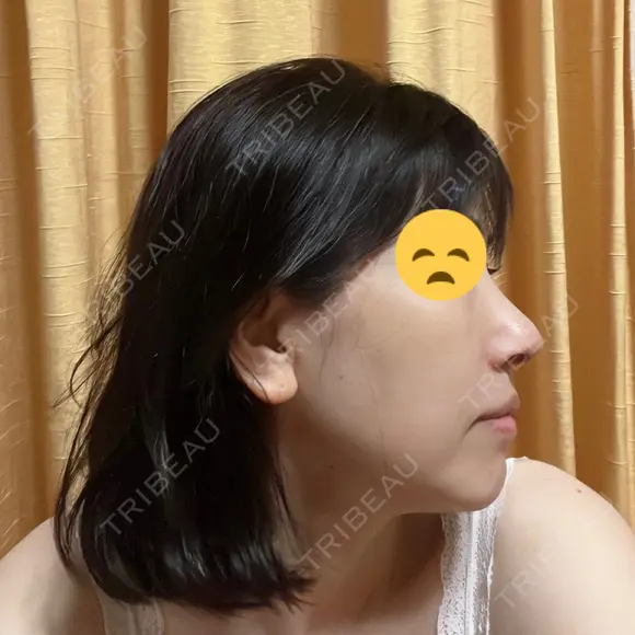 鼻尖形成（切開） / 鼻中隔延長（切開） / 小鼻縮小（切開） / 鼻尖縮小 グローバルビューティークリニック 東京院 DAY 31 メイン用