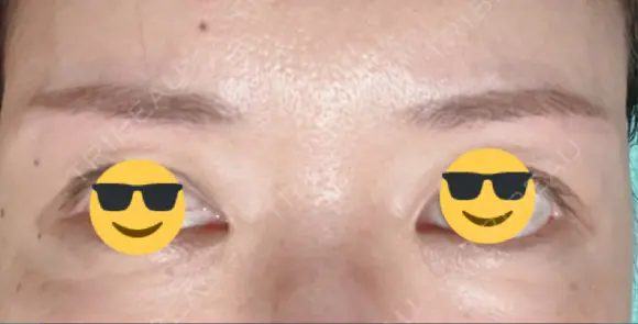 アートメイク（眉） メディカルアートメイク大阪 AFTER メイン用