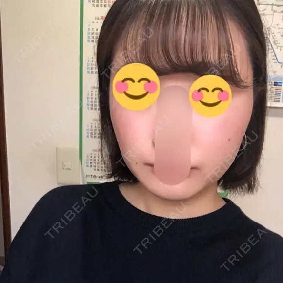 ボトックス（エラ・小顔） 湘南美容クリニック 大宮院 DAY 79 メイン用