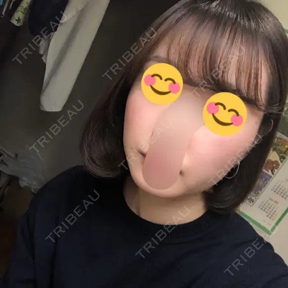 ボトックス（エラ・小顔） 湘南美容クリニック 大宮院 DAY 79 メイン用