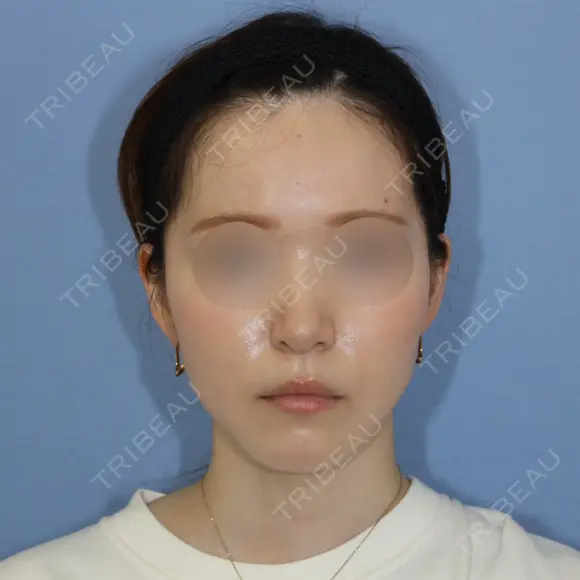 糸リフト / 脂肪吸引（顔） 加藤クリニック 麻布東京院 AFTER メイン用