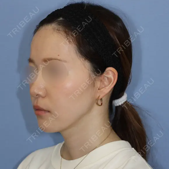 糸リフト / 脂肪吸引（顔） 加藤クリニック 麻布東京院 DAY 117 メイン用