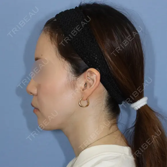 糸リフト / 脂肪吸引（顔） 加藤クリニック 麻布東京院 DAY 117 メイン用