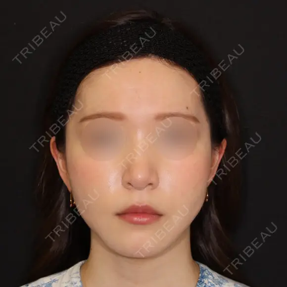 糸リフト / 脂肪吸引（顔） 加藤クリニック 麻布東京院 DAY 30 メイン用