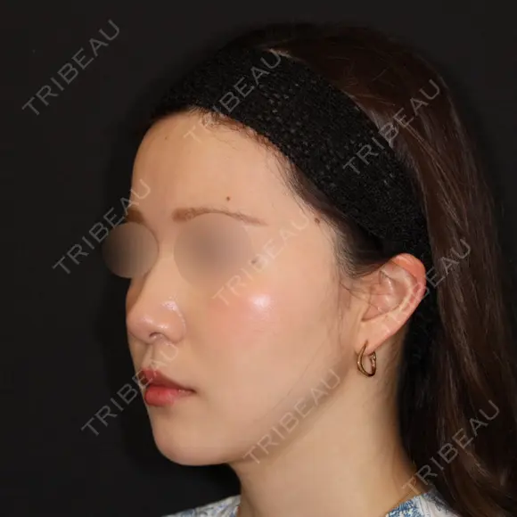 糸リフト / 脂肪吸引（顔） 加藤クリニック 麻布東京院 DAY 30 メイン用