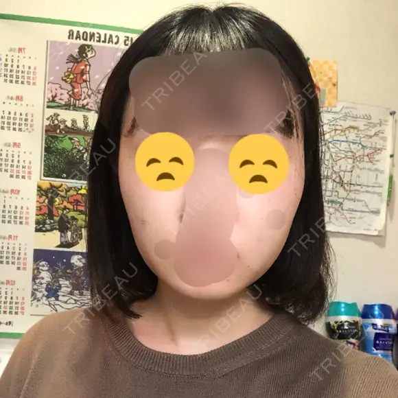 ボトックス（エラ・小顔） 湘南美容クリニック 大宮院 DAY 109 メイン用
