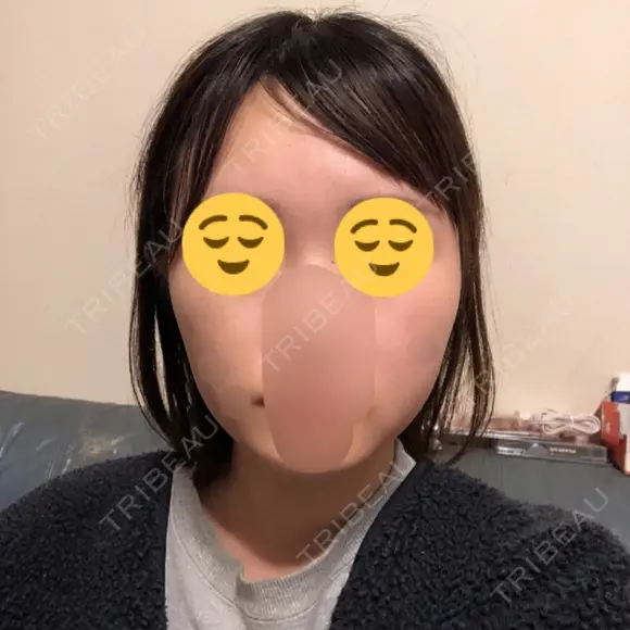 ボトックス（エラ・小顔） 湘南美容クリニック 大宮院 DAY 129 メイン用