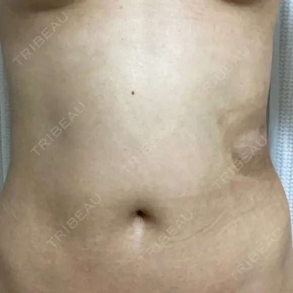 脂肪冷却（お腹） / 脂肪冷却（太もも） / 脂肪冷却（お尻） / 脂肪冷却（背中・ブラファット） 共立美容外科 仙台院 DAY 16 メイン用