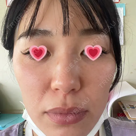 光治療（フォトフェイシャルなど） APOLLO BEAUTY CLINIC DAY 4 メイン用