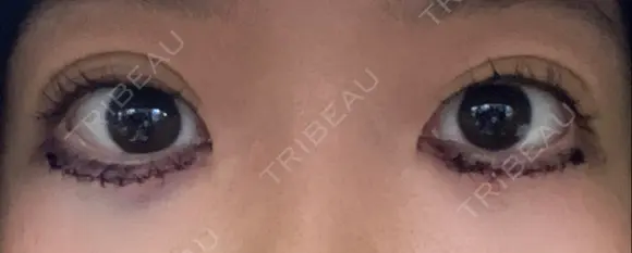 下まぶたたるみ取り きれいクリニック DAY 19 メイン用