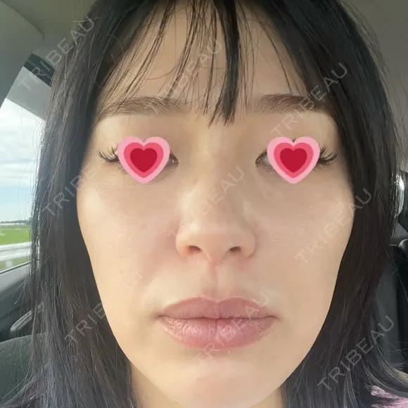 光治療（フォトフェイシャルなど） APOLLO BEAUTY CLINIC DAY 5 メイン用