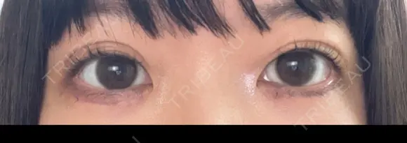 下まぶたたるみ取り きれいクリニック AFTER メイン用