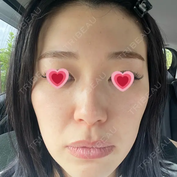 光治療（フォトフェイシャルなど） APOLLO BEAUTY CLINIC DAY 6 メイン用