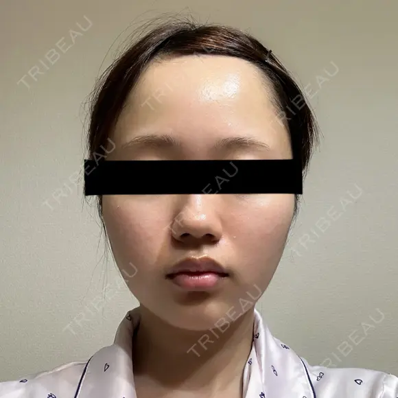 糸リフト / バッカルファット除去 SEA CLINIC（シークリニック） DAY 31 メイン用