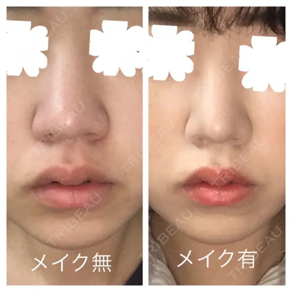 鼻尖形成（切開） / 小鼻縮小（切開） / その他（鼻） / 軟骨移植 JUN CLINIC DAY 42 メイン用