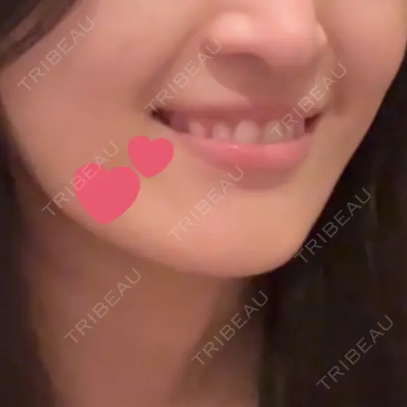 ボトックス（あご） Original Beauty Clinic GINZA DAY 27 メイン用