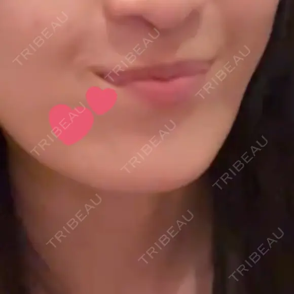 ボトックス（あご） Original Beauty Clinic GINZA DAY 27 メイン用