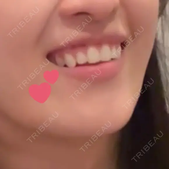 ボトックス（あご） Original Beauty Clinic GINZA DAY 27 メイン用