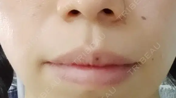 ボトックス（口角） YBC横浜美容外科 大宮院 DAY 36 メイン用