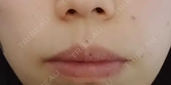 ボトックス（口角） YBC横浜美容外科 大宮院 DAY 37 メイン用