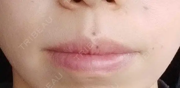 ボトックス（口角） YBC横浜美容外科 大宮院 DAY 38 メイン用